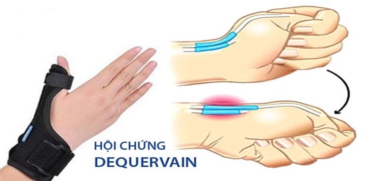 De Quervain syndrome - Hình ảnh minh họa